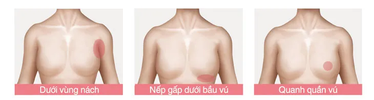 Sơ đồ minh họa vị trí đường mổ nâng ngực: đường nách nội soi, đường chân ngực và đường quầng vú tại Bệnh viện Thẩm mỹ Kangnam.