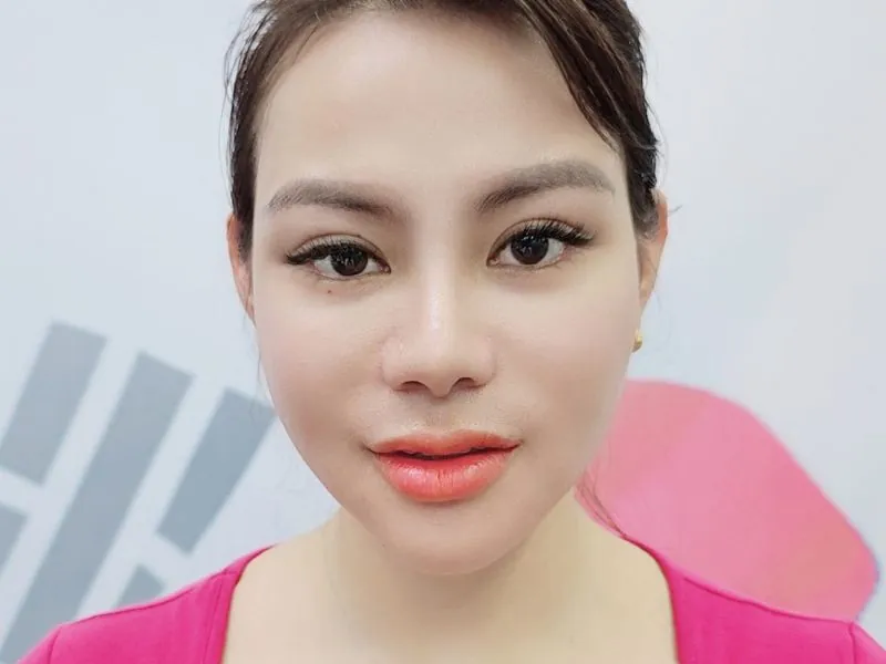 Hành trình hồi phục sau phẫu thuật hạ gò má giúp gương mặt thanh thoát tự nhiên.
