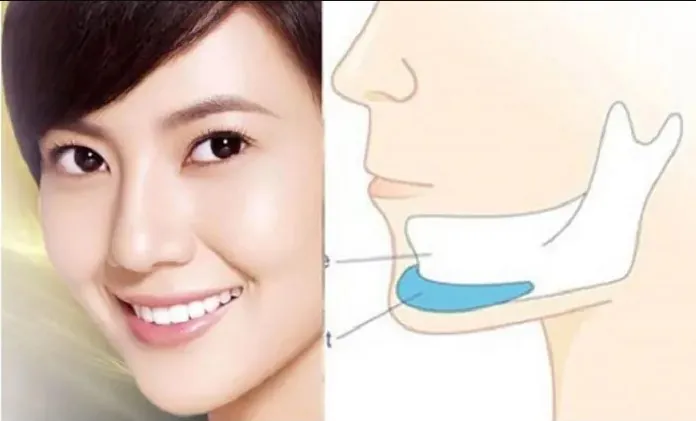 Xương hàm dưới và góc hàm bạnh được mô phỏng 3D trong quy trình phẫu thuật gọt hàm V-line