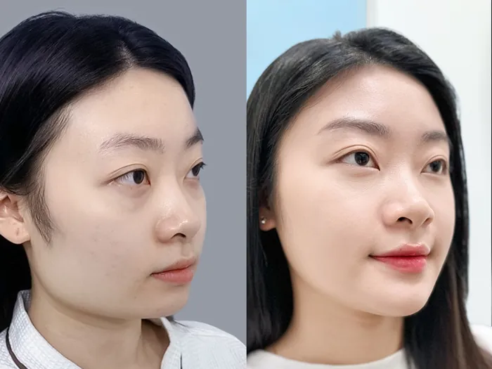 khách hàng hồi phục tốt sau khi gọt hàm tại kangnam