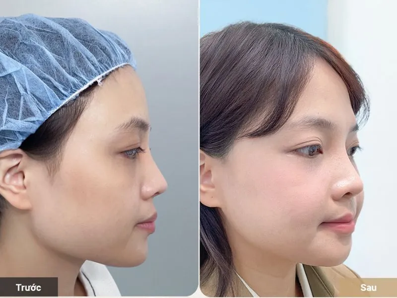 Kết hợp hạ gò má và gọt hàm giúp gương mặt cân đối, hài hòa hơn