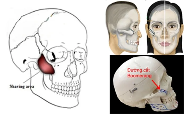 Kỹ thuật cắt xương gò má hình chữ L giúp hạ độ nhô lưỡng quyền từ 3-5mm an toàn