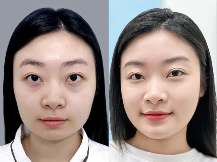 Khách hàng gọt hàm tại Kangnam sở hữu khuôn mặt thanh tú
