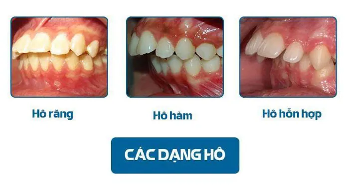 Hô hàm và hô răng có những đặc điểm riêng biệt