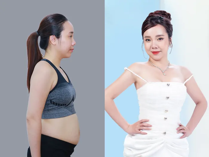 Kết quả trước và sau khi thực hiện combo hút mỡ bụng đùi tay giúp tiết kiệm chi phí và tạo đường nét cơ thể đồng bộ.