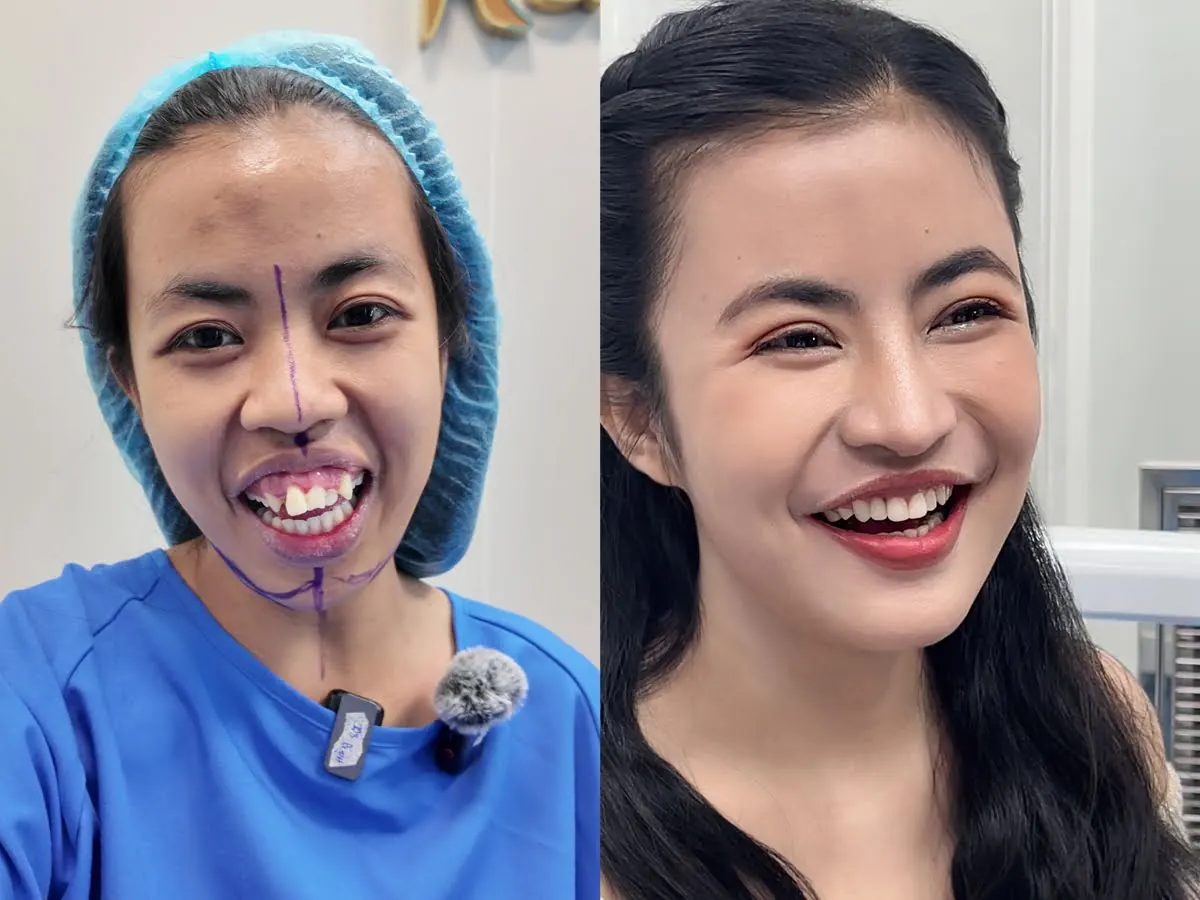 Kangnam phẫu thuật thẩm mỹ phong cách tự nhiên, hài hòa