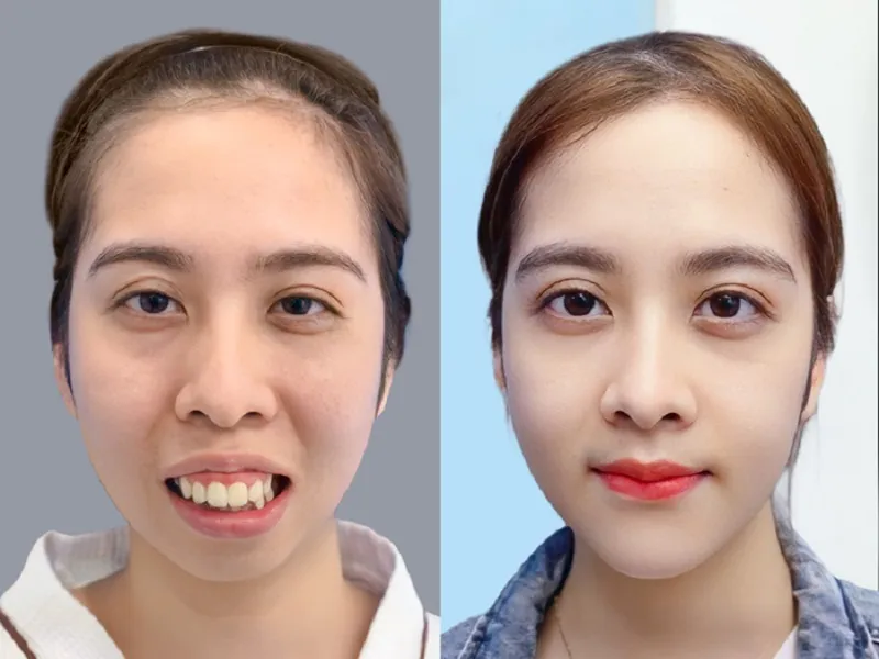 Kết quả chỉnh hàm hô của khách hàng tại Kangnam Hà Nội