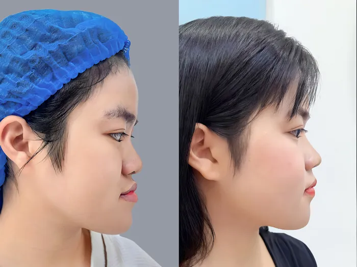 Trường hợp khách hàng bị móm được chỉnh hàm tại Kangnam