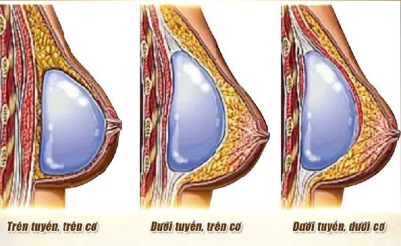 So sánh các kỹ thuật đặt túi dưới cơ ngực