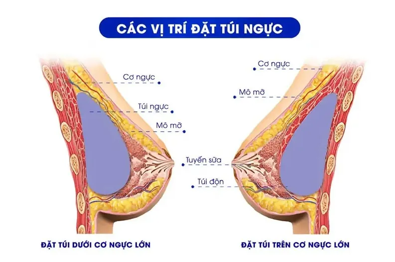 Kỹ thuật đặt túi ngực dưới cơ giảm bao xơ, không ảnh hưởng đến tuyến sữa
