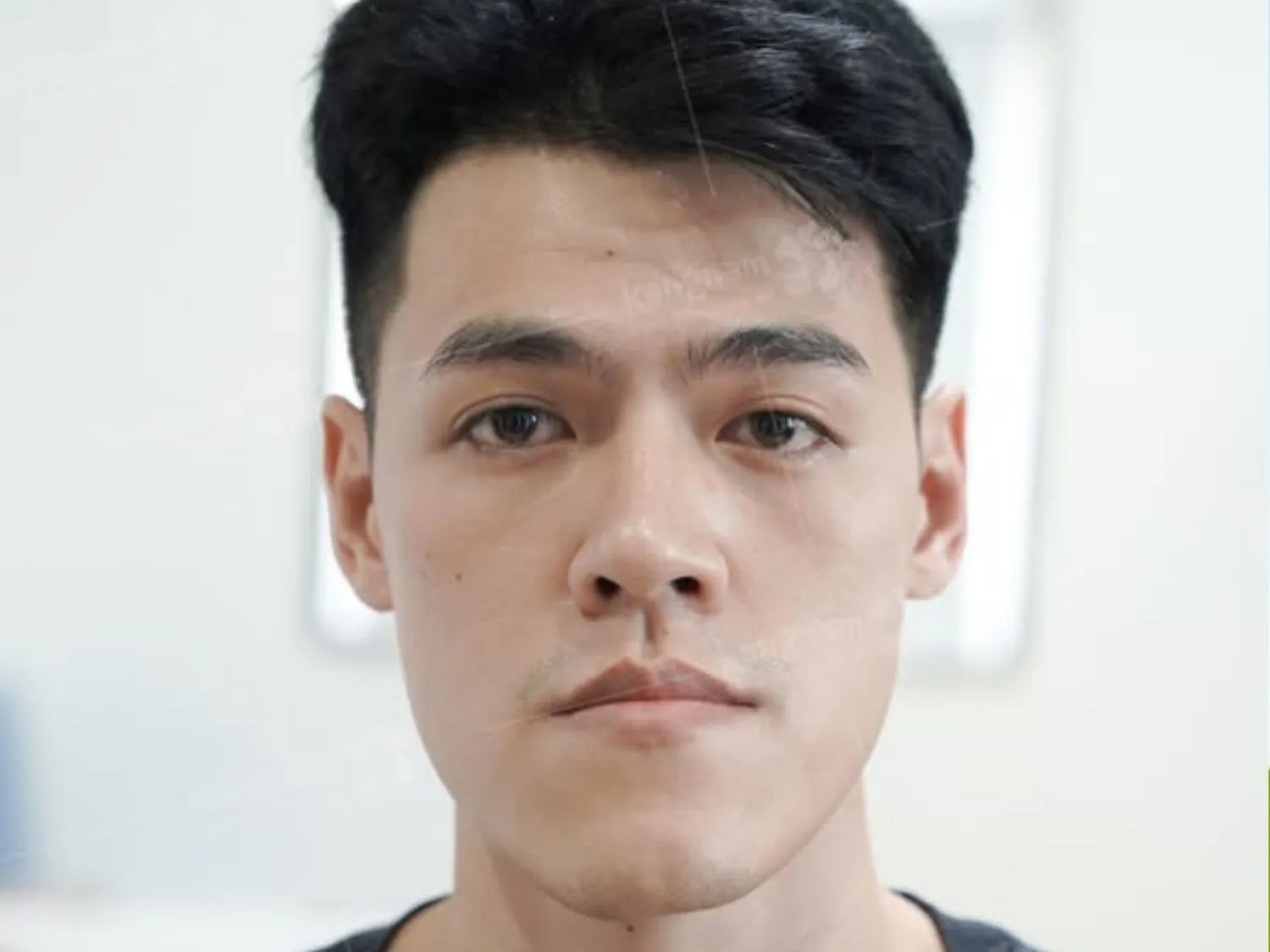 hàm lệch bẩm sinh