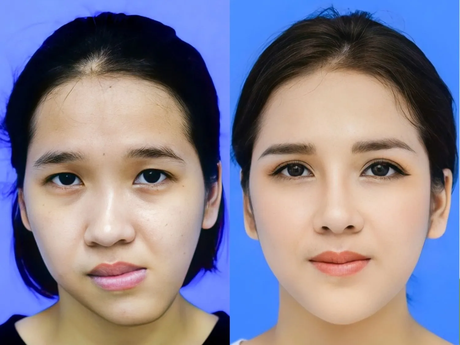 tình trạng lệch hàm do xương và sau khi được cải thiện hoàn chỉnh