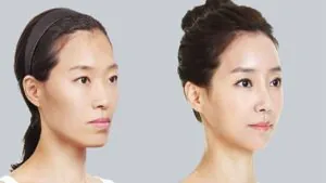 Mặt gò má cao nên làm gì? Cách khắc phục theo từng nguyên nhân và mức độ
