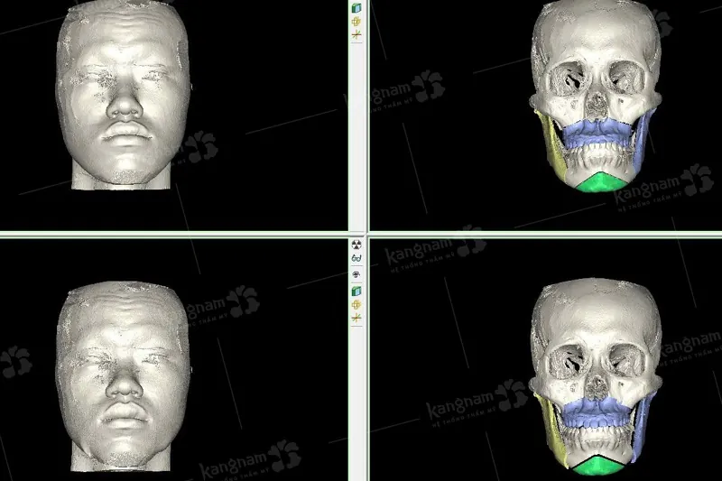 Công nghệ hình ảnh mô phỏng AI face giúp xác định chính xác vị trí dây thần kinh và lượng xương cần cắt bỏ.