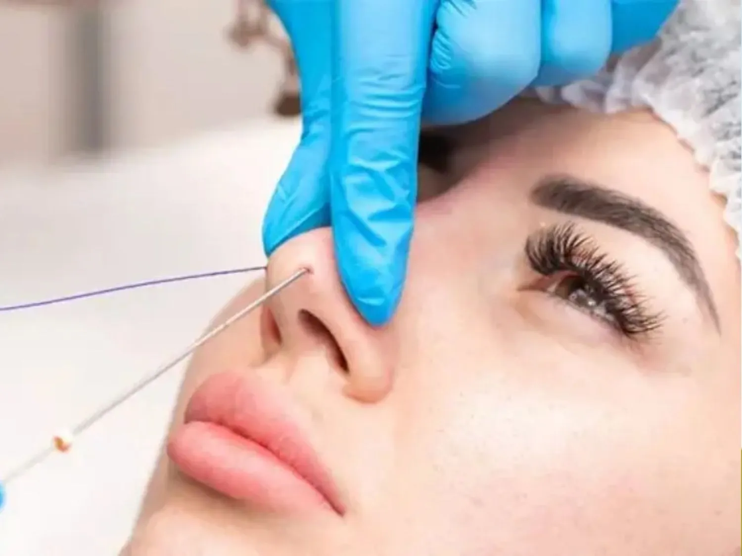 bác sĩ đang sử dụng các sợi chỉ sinh học đưa vào dưới da mũi để nâng đỡ và tạo hình dáng mũi cao hơn