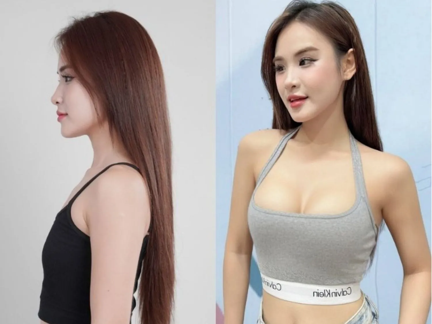 túi ngực vẫn đẹp và ổn định thì không cần thay