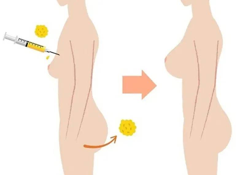 Mỡ tự thân được lấy từ các vùng nhiều mỡ thừa và cấy lên ngực