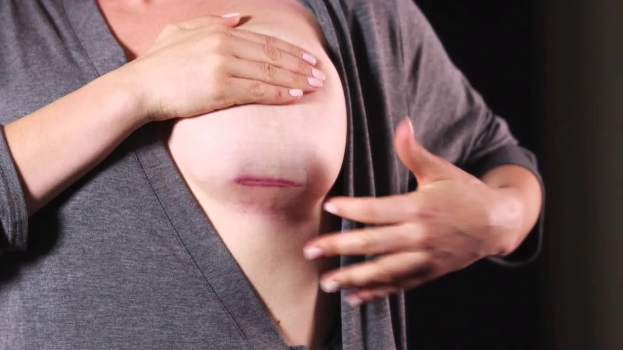 Túi ngực bị hoại tử khi nhiễm trùng, tổn thương hoặc dùng túi độn kém chất lượng