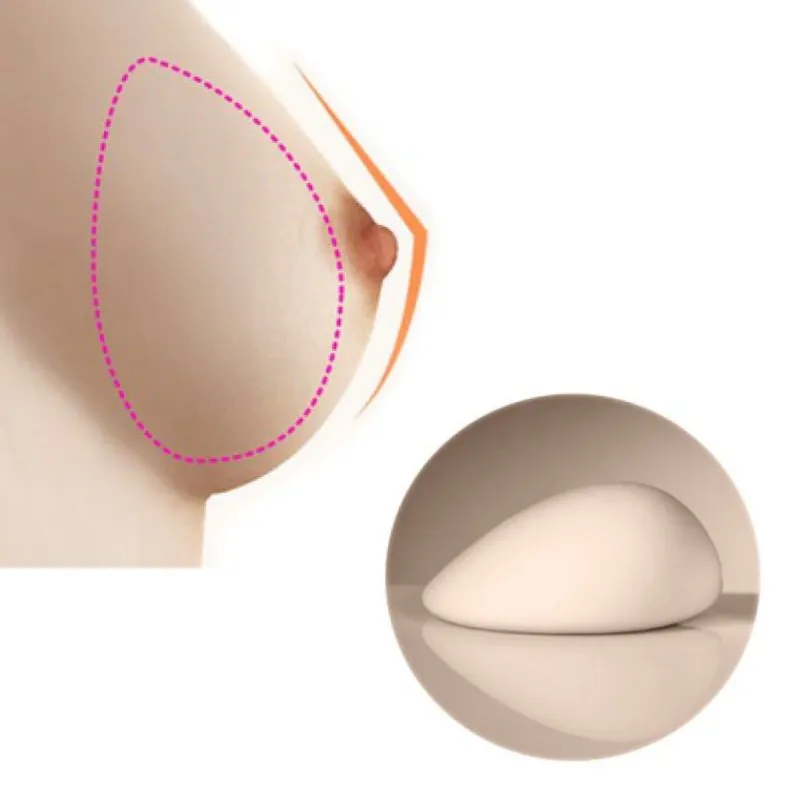 Túi ngực luôn nằm ngoài khung xương sườn, không có khả năng xâm nhập vào khoang nội tạng.