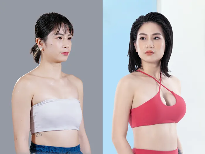 Túi Ergonomix giúp tạo dáng ngực mềm mại và chuyển động linh hoạt theo cơ thể khách hàng