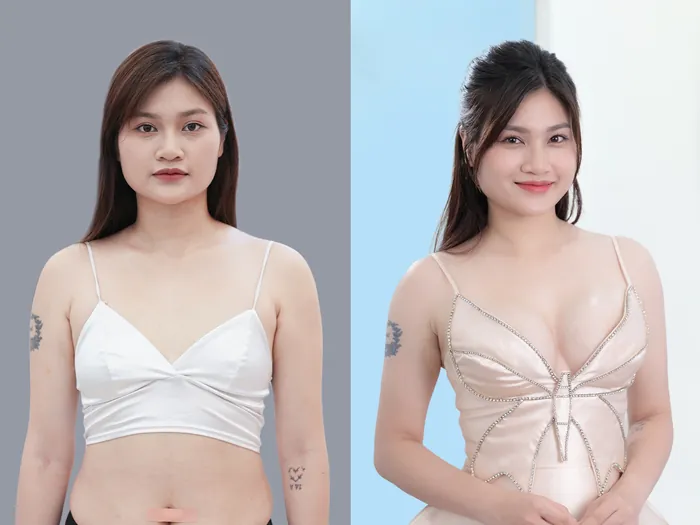 khách hàng sau nâng ngực 1 tuần, cơ bản đã ổn định và vẫn đang trong quá trình hoàn thiện mô mềm