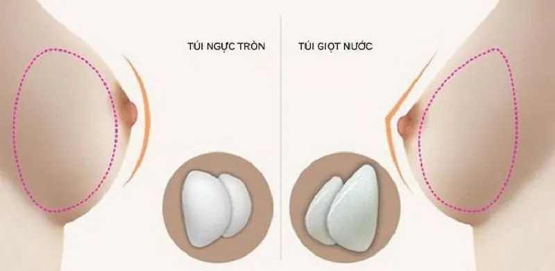 Sơ đồ so sánh cấu trúc túi tròn và túi giọt nước tại Bệnh viện Thẩm mỹ Kangnam.