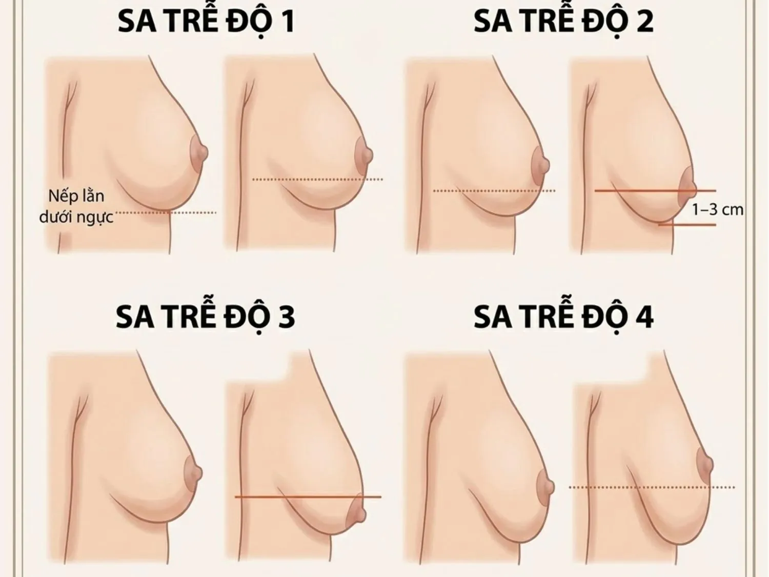 mô phỏng 4 cấp độ sa trễ ngực