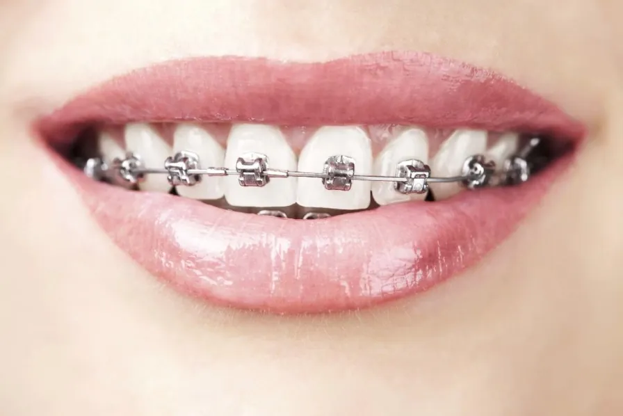 Phương pháp niềng răng điều trị móm nhẹ hiệu quả và thẩm mỹ.
