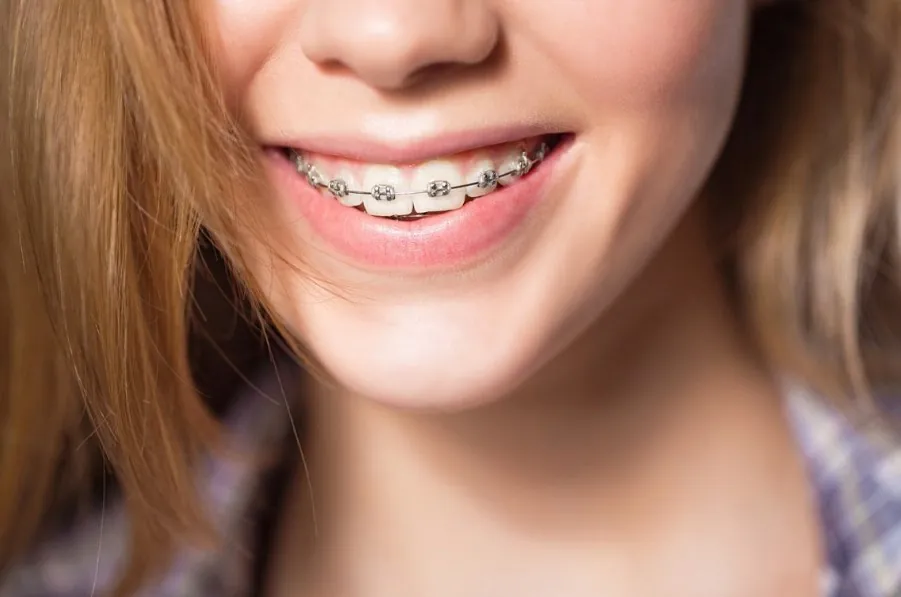 Niềng răng áp dụng cho trường hợp răng bị chìa ra ngoài