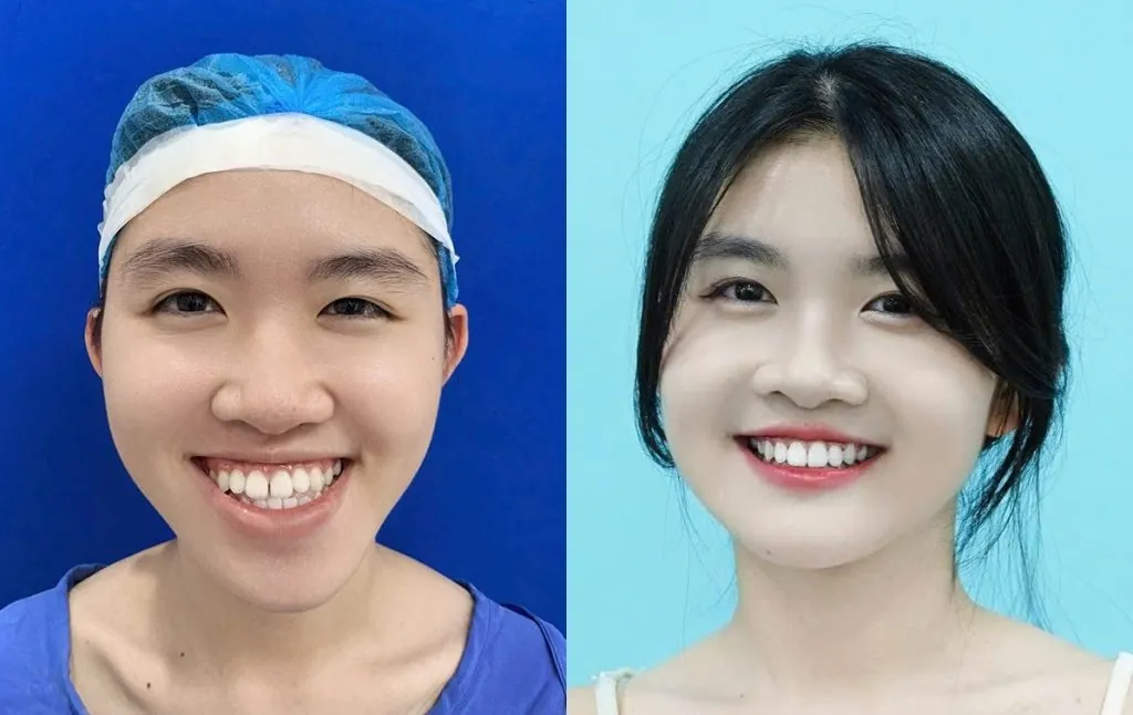 khách hàng kangnam sở hữu khuôn mặt cân đối sau khi chỉnh hàm lệch