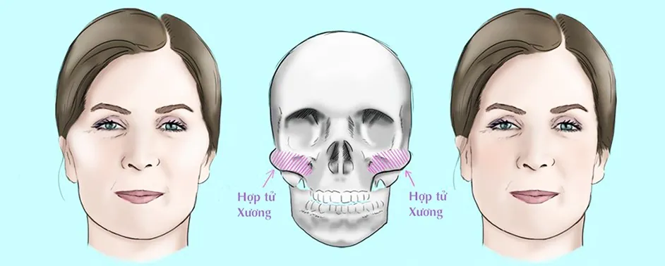 So sánh vị trí can thiệp xương hàm dưới và xương gò má trong phẫu thuật tạo hình khuôn mặt