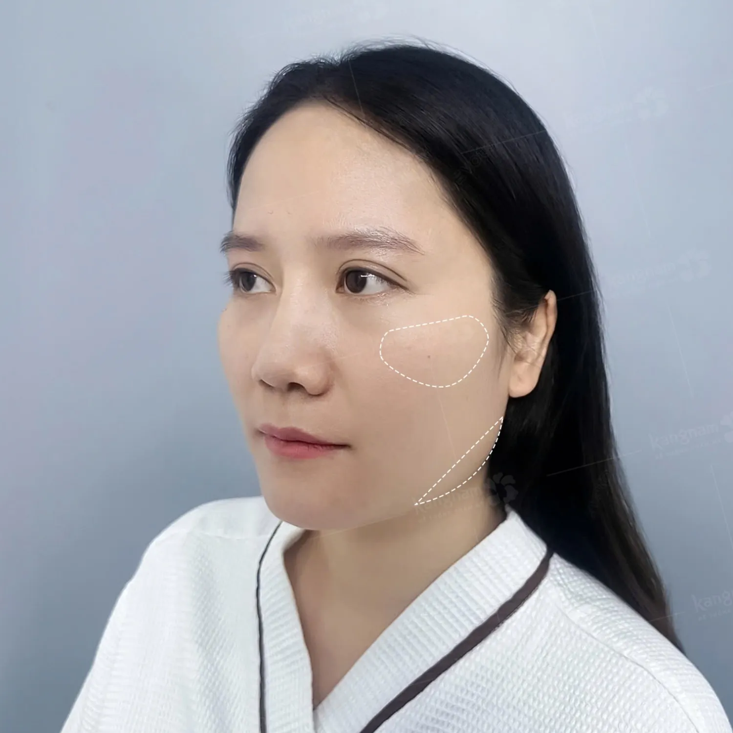 Gò má cao, xương nhô cao nên thực hiện hạ gò má