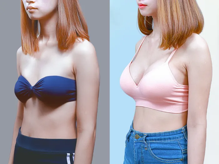 Treo sa trễ kết hợp nâng ngực để khắc phục ngực chảy xệ