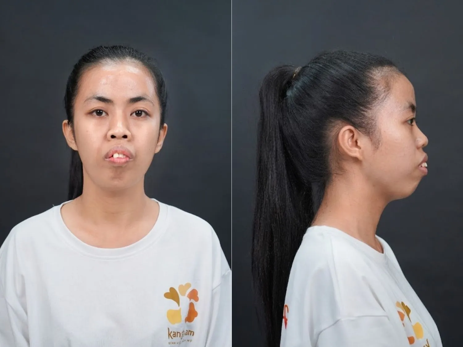 Tình trạng của Trà My trước phẫu thuật