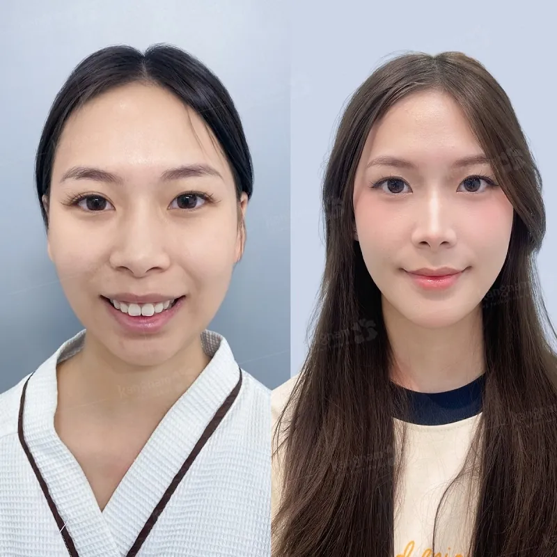 Kết hợp độn cằm cùng với chỉnh hàm hô giúp gương mặt cân đối, thanh thoát hơn