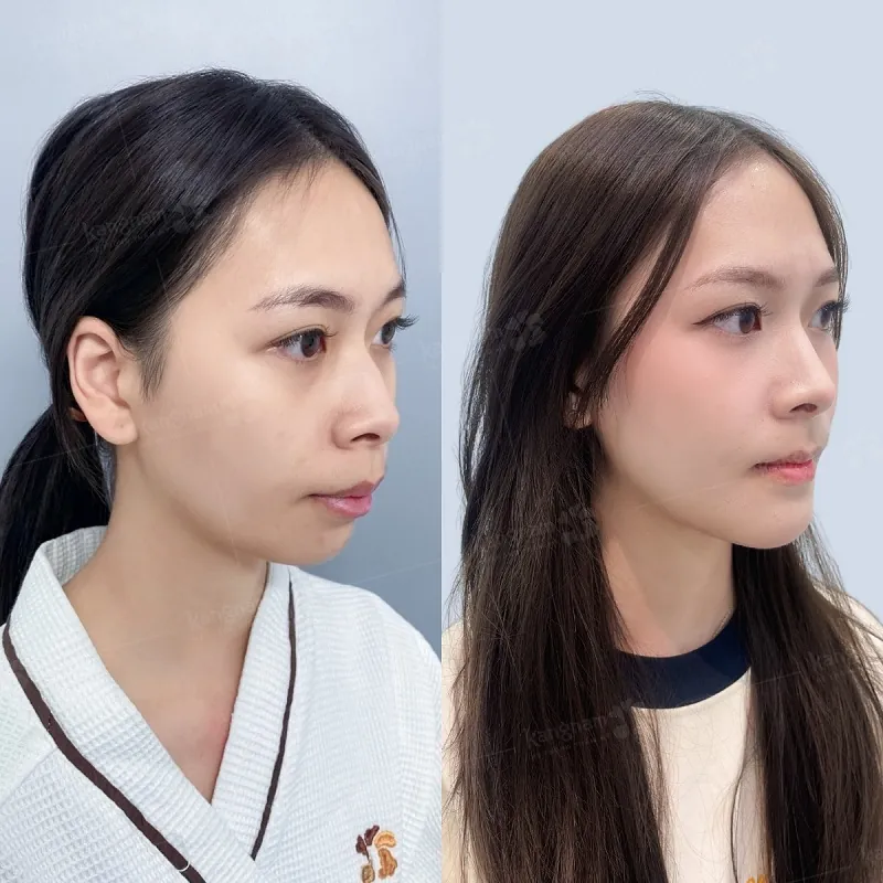 So sánh góc nghiêng cằm ngắn và cằm lẹm thực tế tại Bệnh viện Thẩm mỹ Kangnam để lựa chọn phương pháp can thiệp phù hợp.