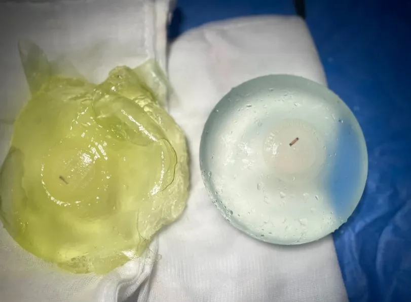 Túi nâng ngực bịu bao xơ cần phải tháo