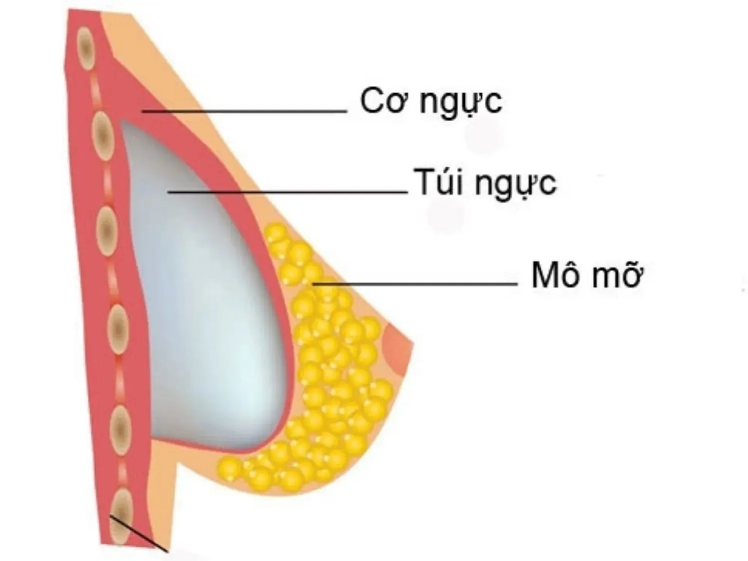nâng ngực không ảnh hưởng tuyến sữa, mô phỏng vị trí đặt túi ngực dưới cơ không ảnh hưởng đến tuyến sữa