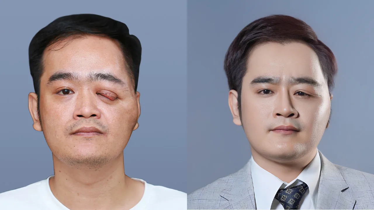 Thanh Hưng tự tin tỏa sáng sau khi tạo hình mắt