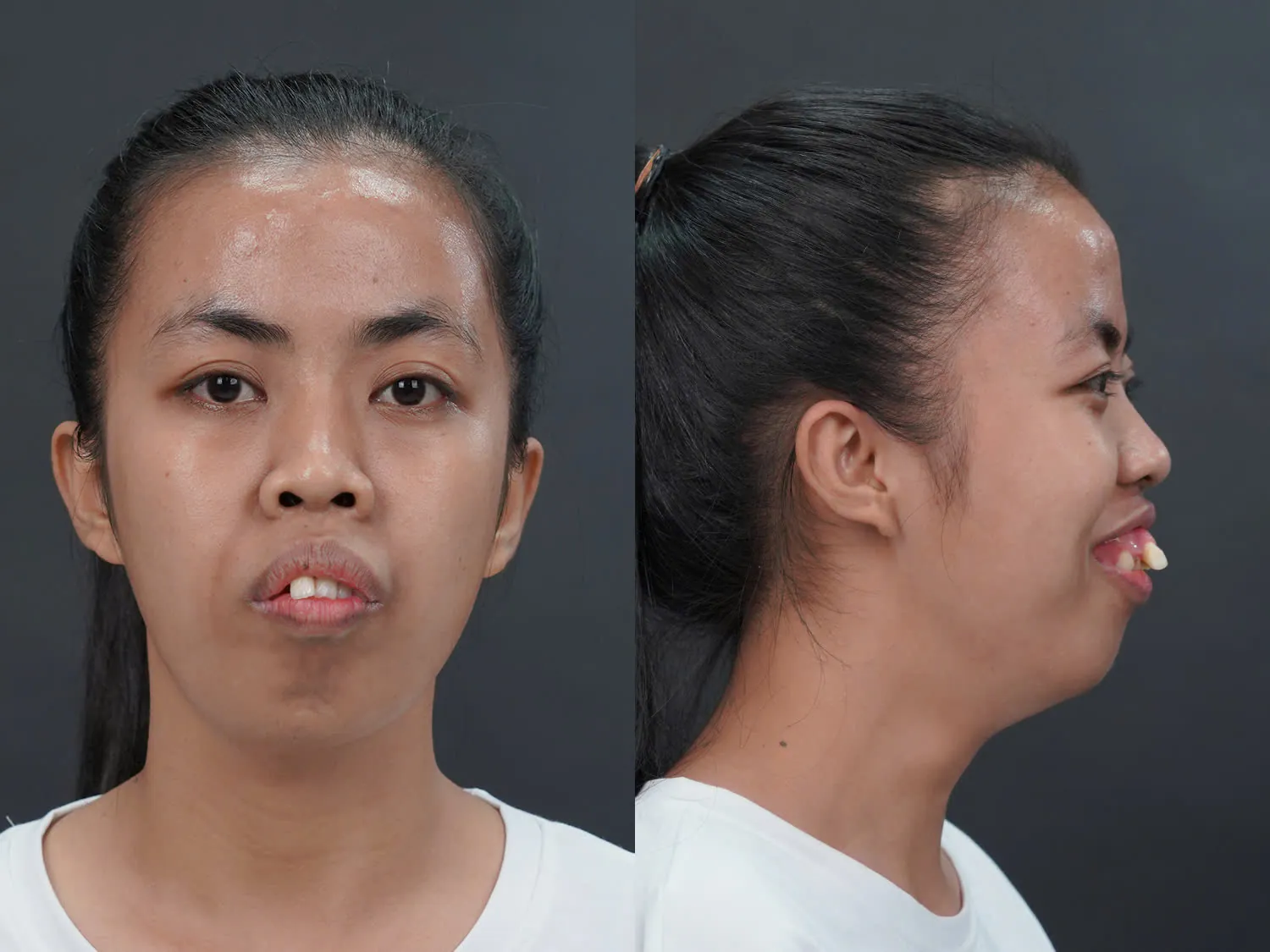 tình trạng mũi thấp, cánh mũi dày và to của Trà My trước khi đến hành trình lột xác của kangnam