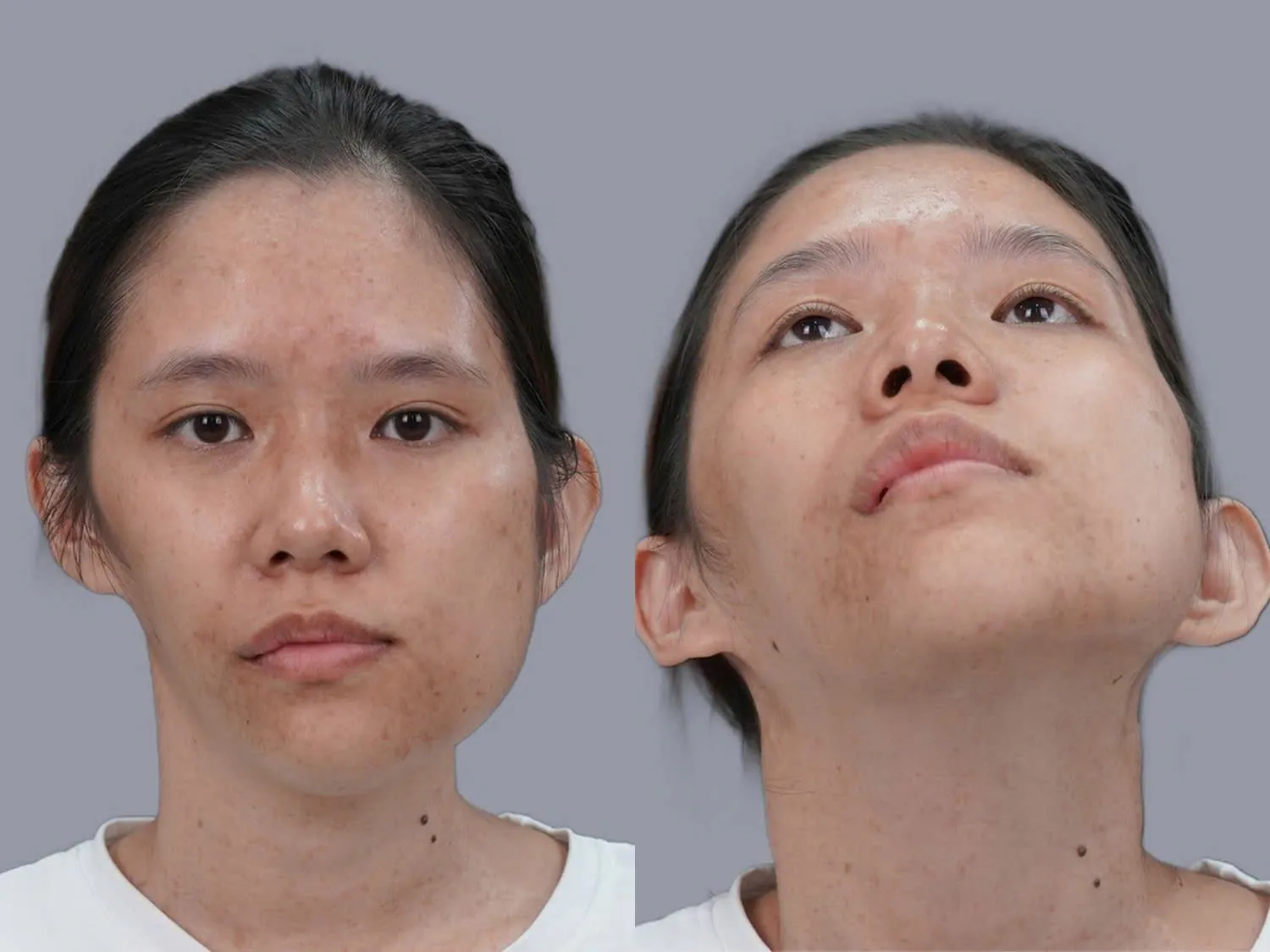 Bảo gặp gặp tình trạng mặt lệch, bên hàm trái phát triển quá mức, mặt bên phải teo lóp mất cân đối, sống mũi thấp