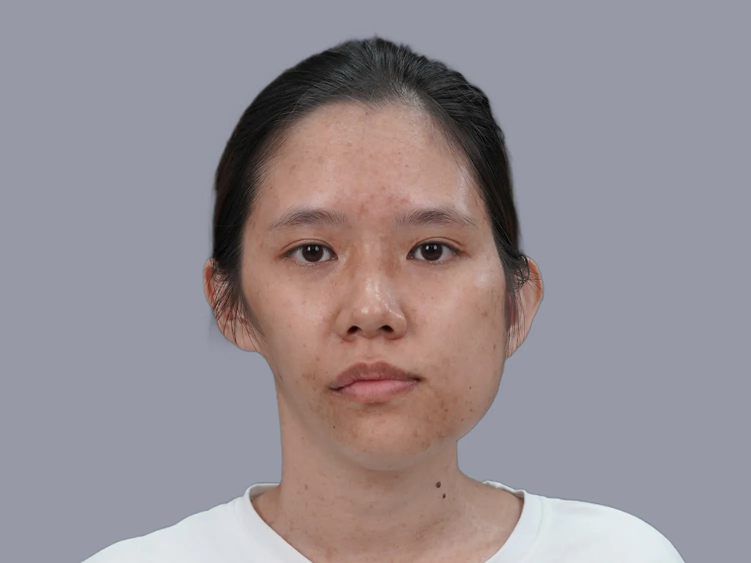 Võ Trần Bảo Ngọc gặp tình trạng một bên xương hàm phì đại, bên còn lại teo lép, mặt lệch, dáng mũi thấp