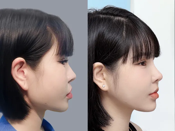 khách hàng Kangnam trước và sau khi gọt hàm vẫn duy trì sức khỏe và vùng hàm ổn định