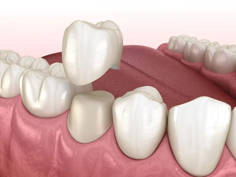 Trường hợp răng khấp khểnh sau chỉnh hàm có thể thực hiện bọc răng sứ