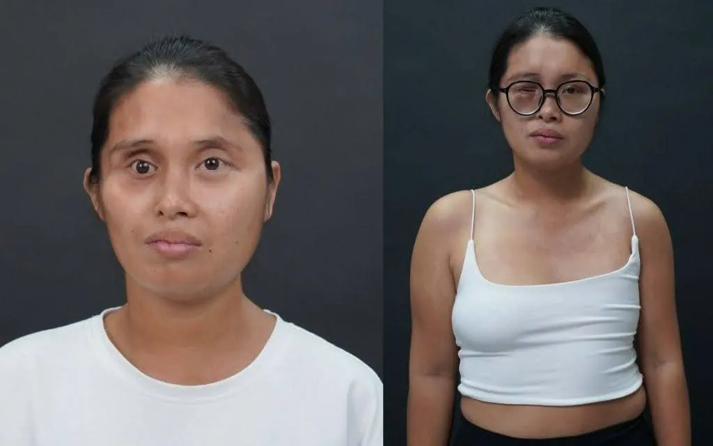 Lê Thị Yến gặp tình trạng mặt lệch, hốc mắt teo, mắt bên phải bị hỏng, ngực bị teo lép, vòng 2 không đều