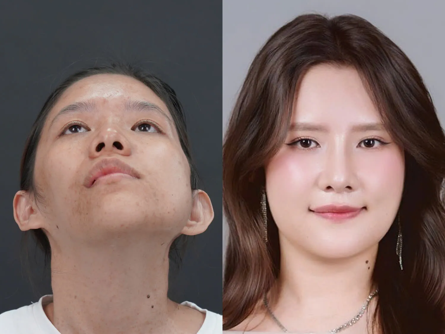 Bảo Ngọc trước và sau phẫu thuật khác biệt hoàn toàn, gương mặt cân đối và hài hòa hơn