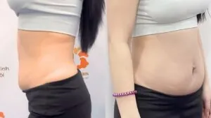 Giảm mỡ Zero Fat xong có béo lại không? Sự thật về cơ chế chống tái béo sau giảm mỡ