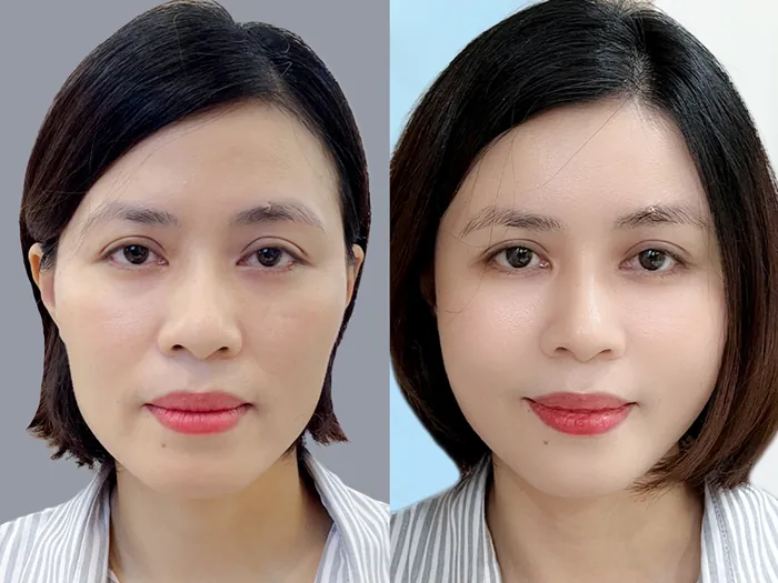 khách hàng trước và sau khi cấy mỡ mặt tại Kangnam, gương mặt trẻ trung và cân đối hơn