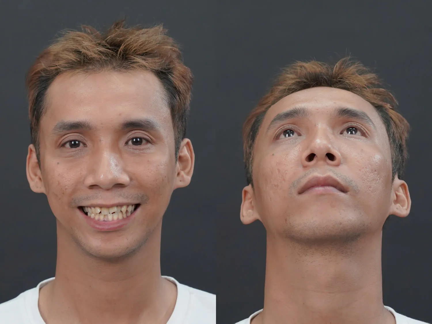 Tình trạng hàm hô cằm lẹm và sẹo rỗ của Lê Chí Nguyện trước khi phẫu thuật thẩm mỹ.