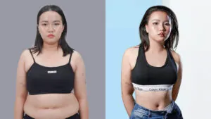 Kỳ tích giảm 12cm eo của Gia Hân với gói ZeroFat tại Kangnam